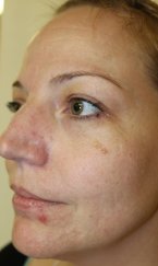 Vampire Facial 7 - Before Treatment